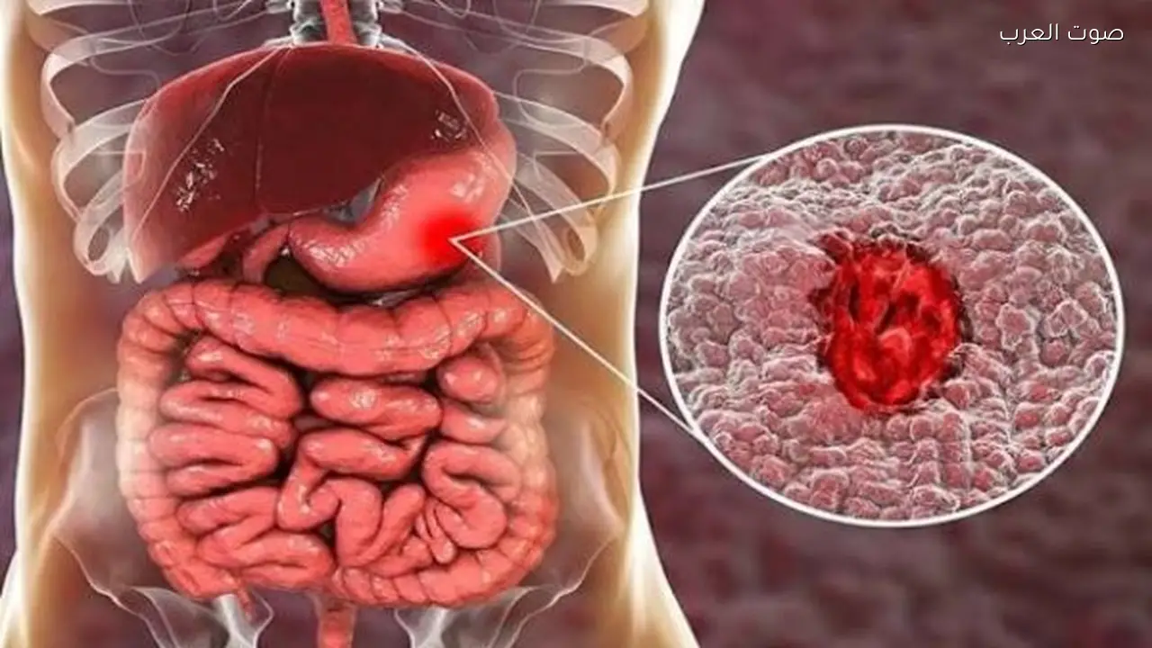 أسباب ومضاعفات التهاب القولون التقرحي غير العصبي