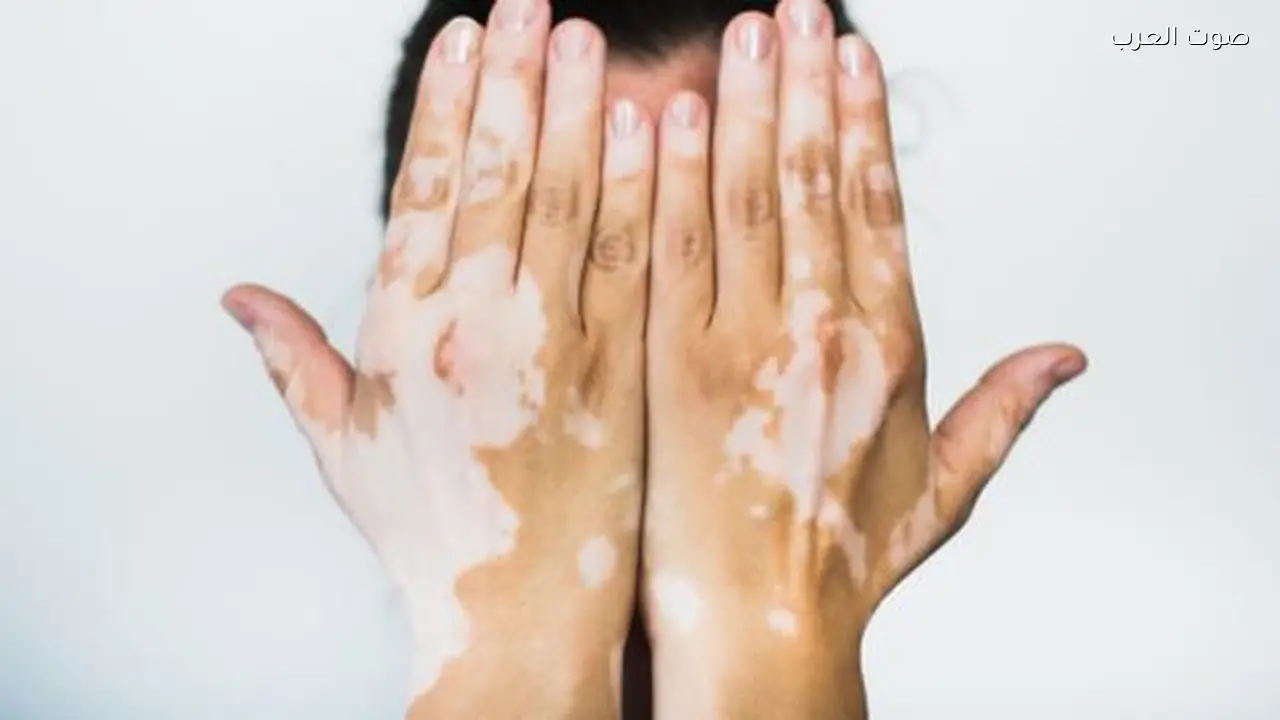 اكتشاف علاج جديد للبهاق يعالج المرض من داخل الجسم