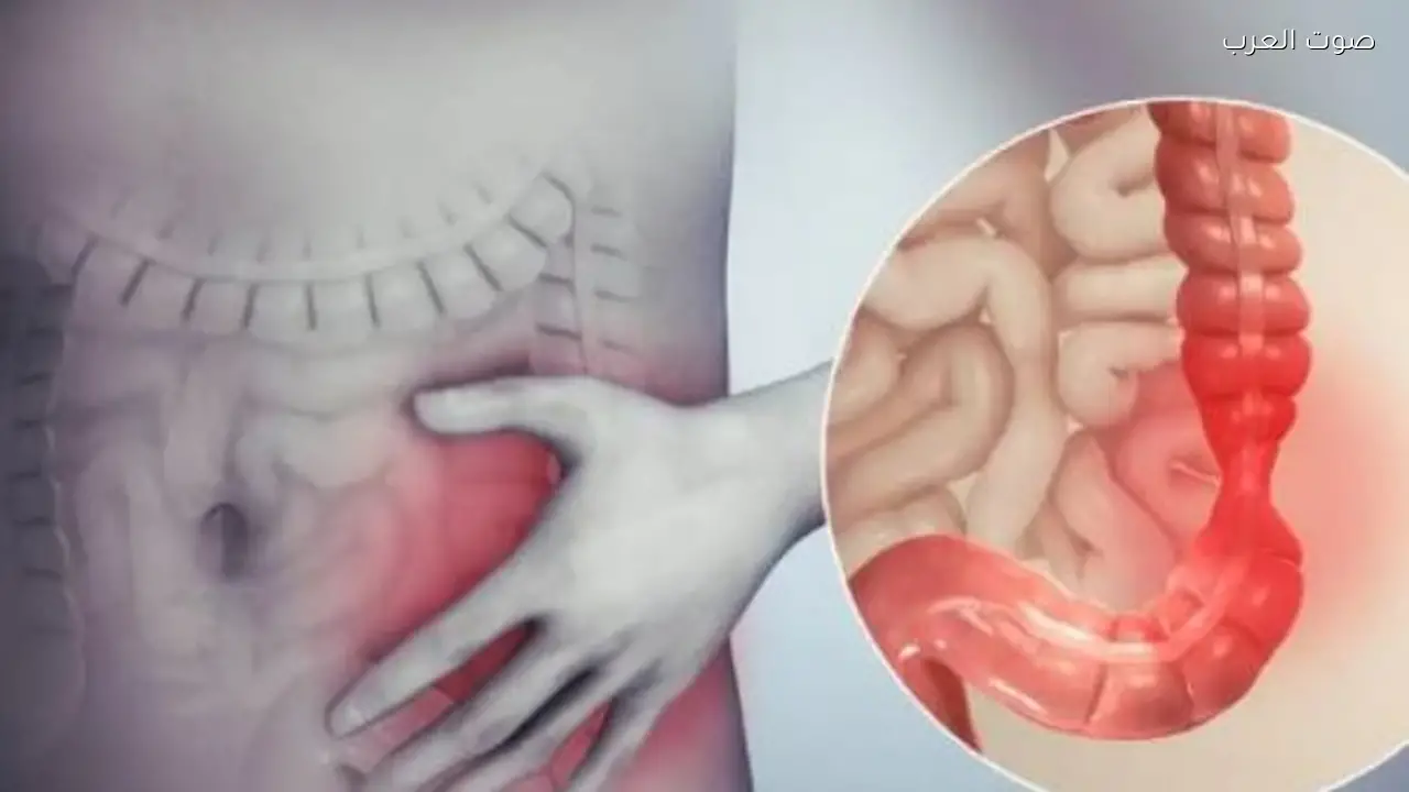 التهاب القولون التقرحي: الأعراض الرئيسية التي يجب معرفتها