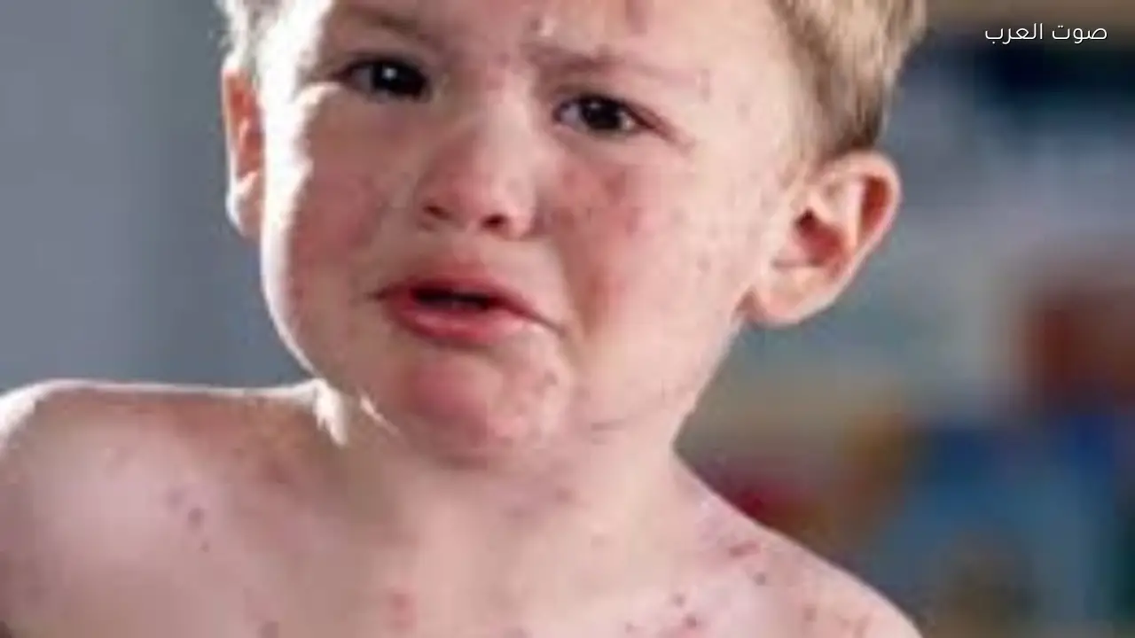 تفشي مرض معدي في ولاية مكسيكية تستضيف كأس العالم 2026