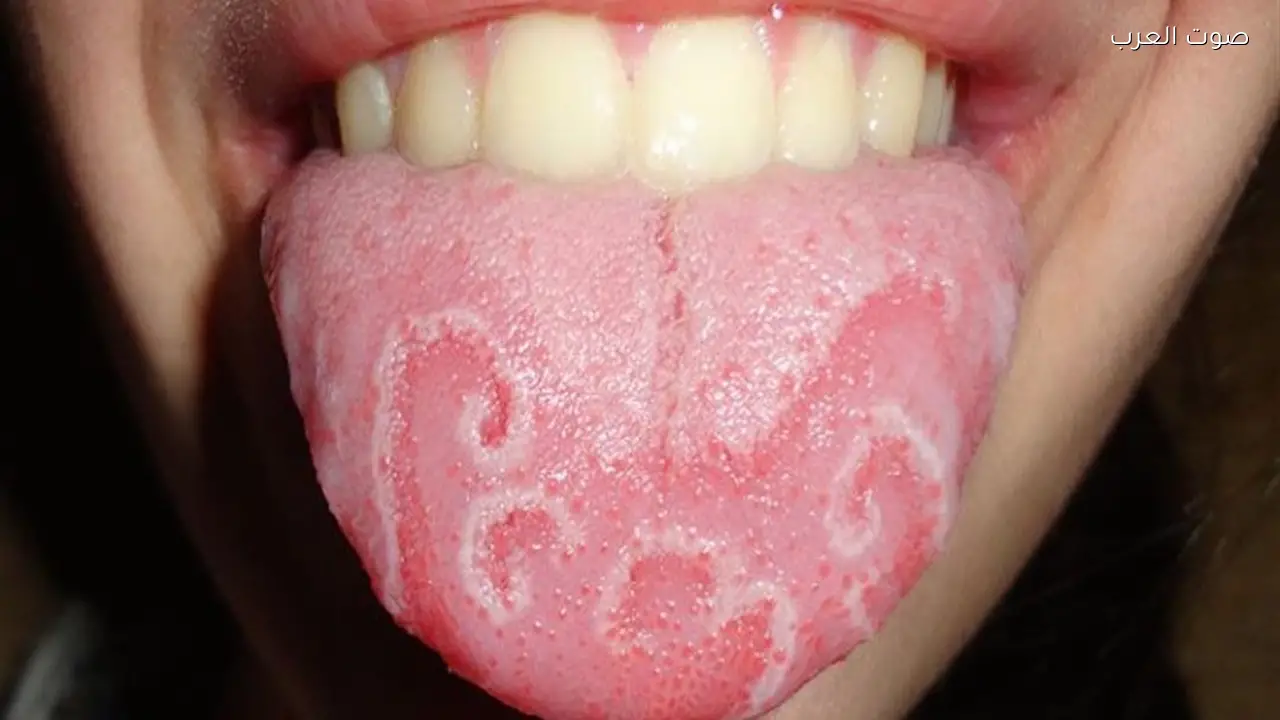 عرض في لسانك قد يشير إلى مرض خطير