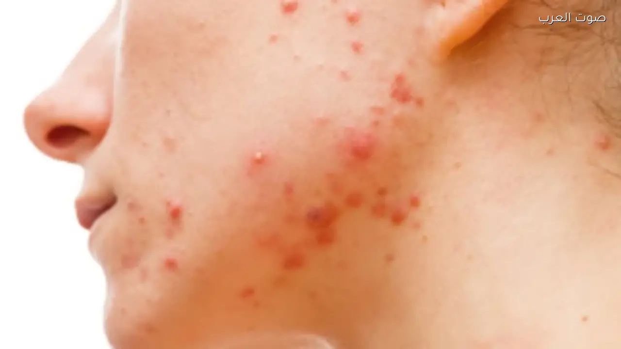 علامات تحذيرية: البثور قد تشير لمشكلات صحية أخرى