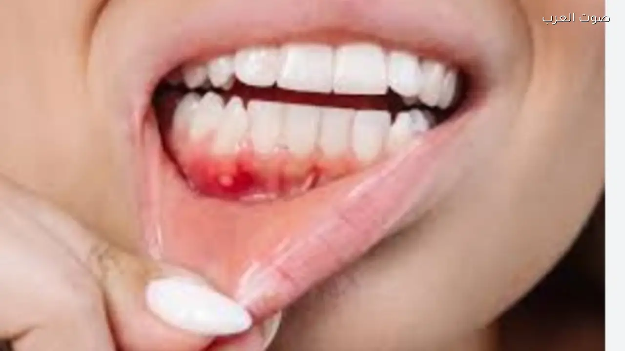 علامات مبكرة لسرطان الفم والحلق يجب معرفتها