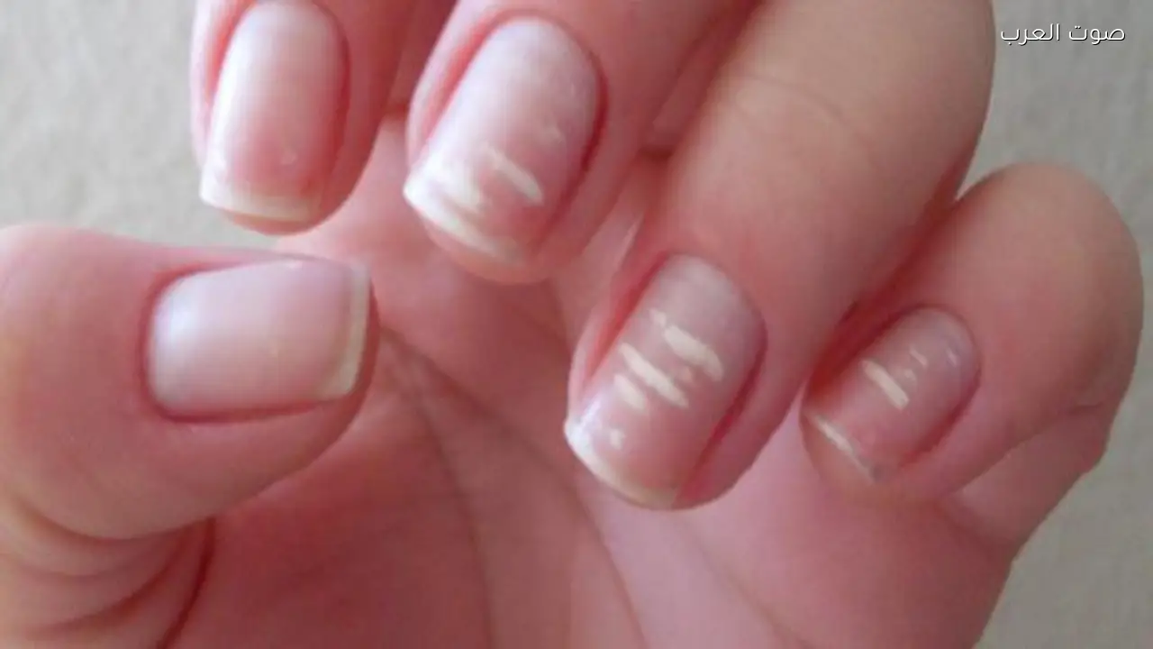 علامة على أظافرك قد تشير إلى خطر صحي خفي