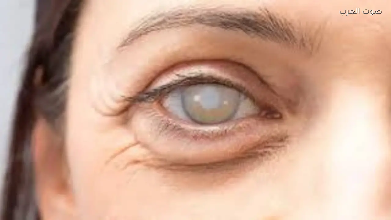مياه بيضاء تؤثر على البصر طبيب يكشف أسراراً مهمة عن العيون