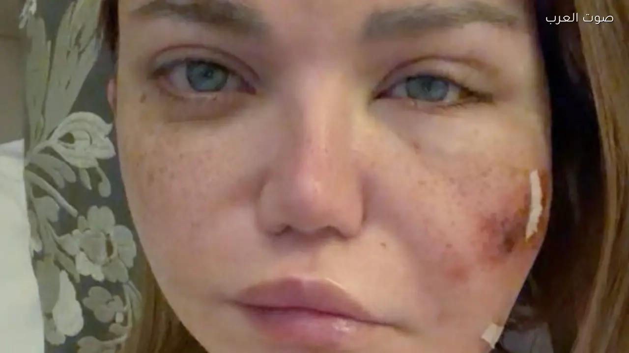 ياسمين الخطيب تعلن إصابتها بعدوى بكتيرية في وجهها